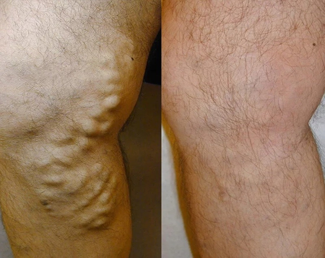 VEYRA customer-submitted before and after photo