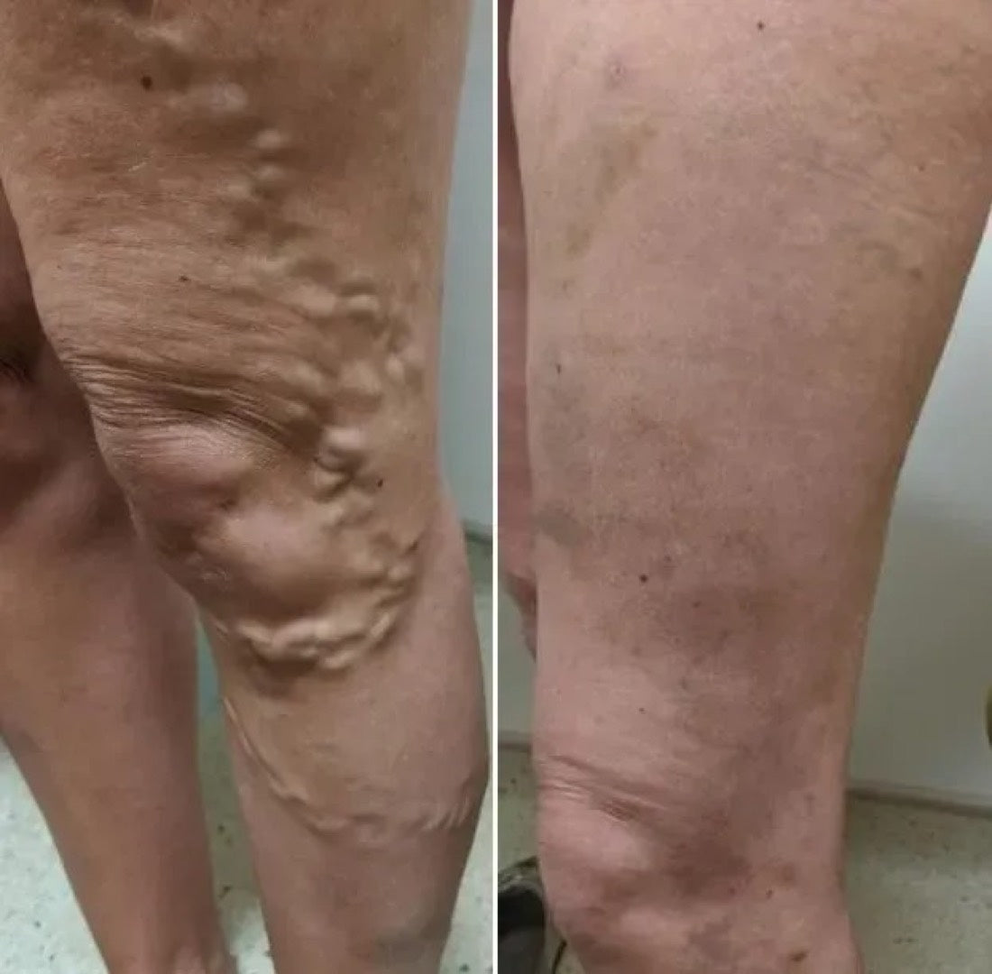 VEYRA customer-submitted before and after photo