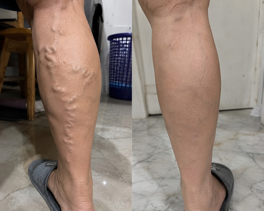 VEYRA customer-submitted before and after photo